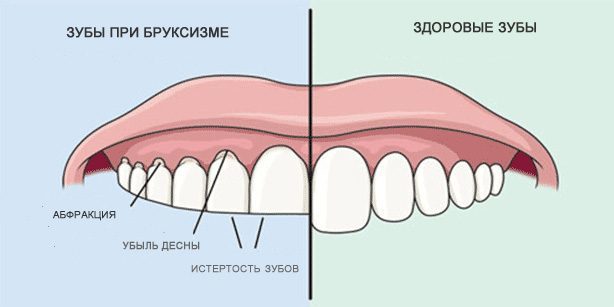 Dişler taşlama: Sağlıklı diş ve diş bruksizm sırasında