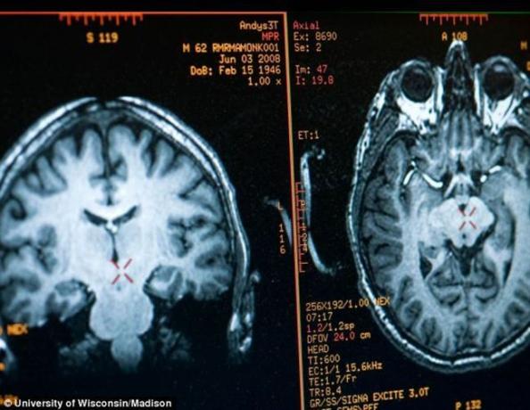 Beyin Matthieu Ricard görüntü MRI ile elde