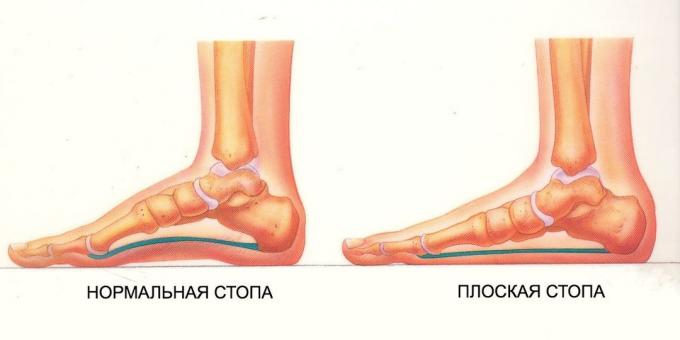 Normal ve düz ayak: düz ayak egzersizleri