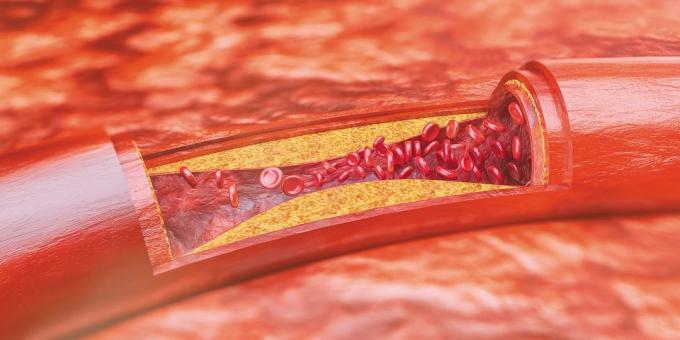 Kolesterol: aterosklerotik plaklar