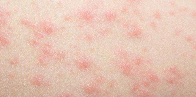 İlaç alerjisi olan deri döküntüsü